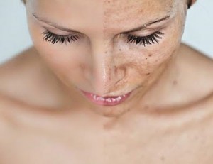 Troubles de la pigmentation