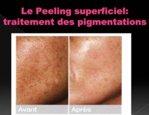 Peeling superficiel