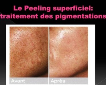 Peeling superficiel