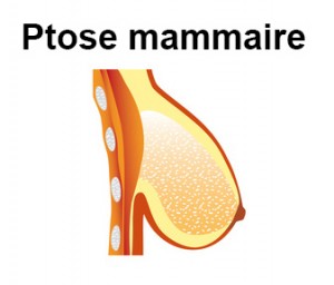 La ptose mammaire